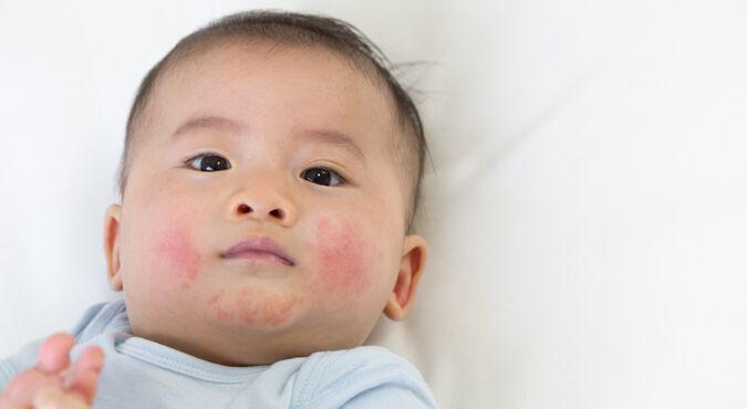 Bebê com bochechas avermelhadas com rash cutâneo