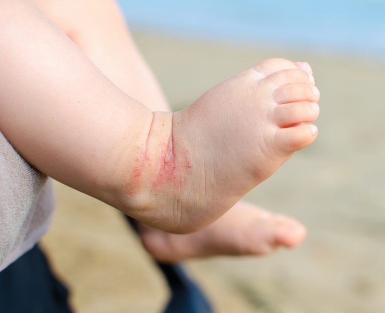 Dicas para o tratamento do eczema em seu filho