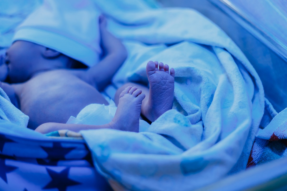 Bebê recebendo fototerapia neonatal com banho de luz azul
