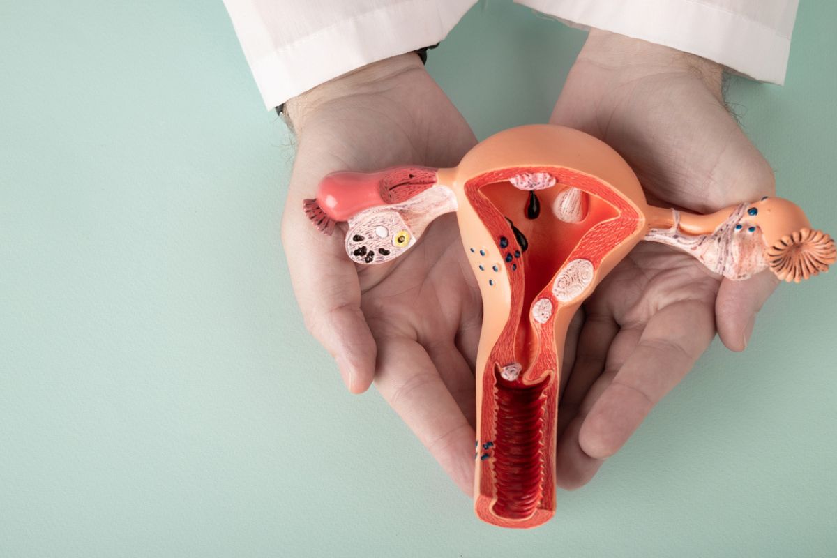 Imagem de maquete de utero com pontos mais escuros simbolizando lesões de endometriose