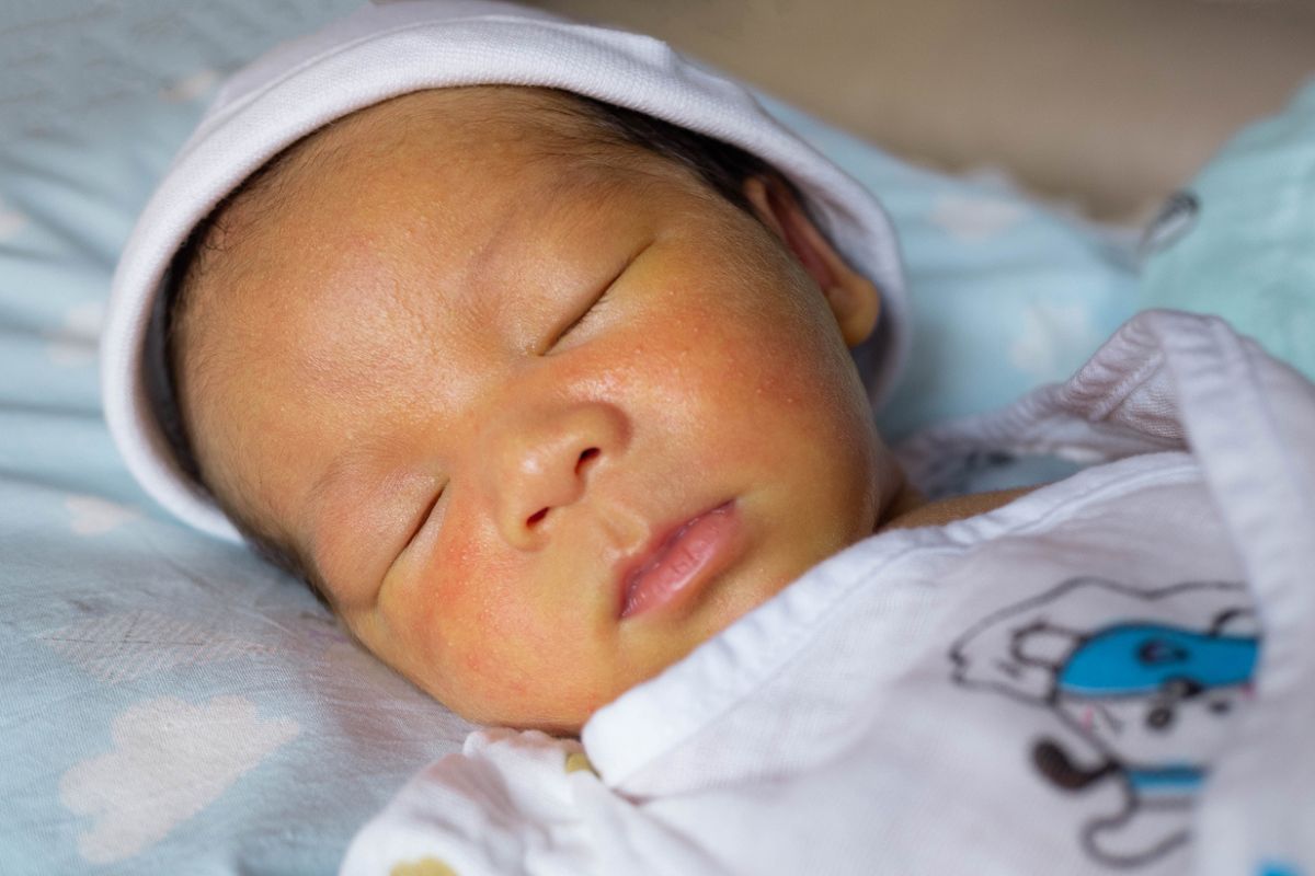 Bebe recém-nascido com pele amarelada por ictericia